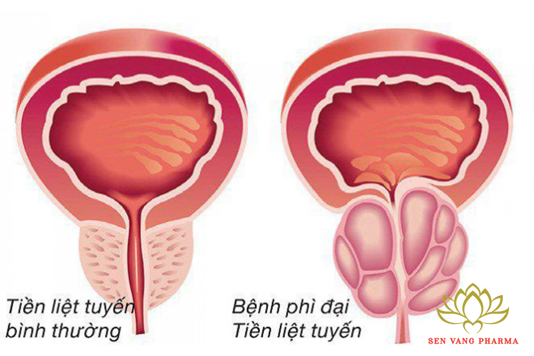 Bệnh liên quan đến tuyến tiền liệt